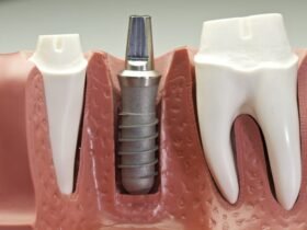 dental implants