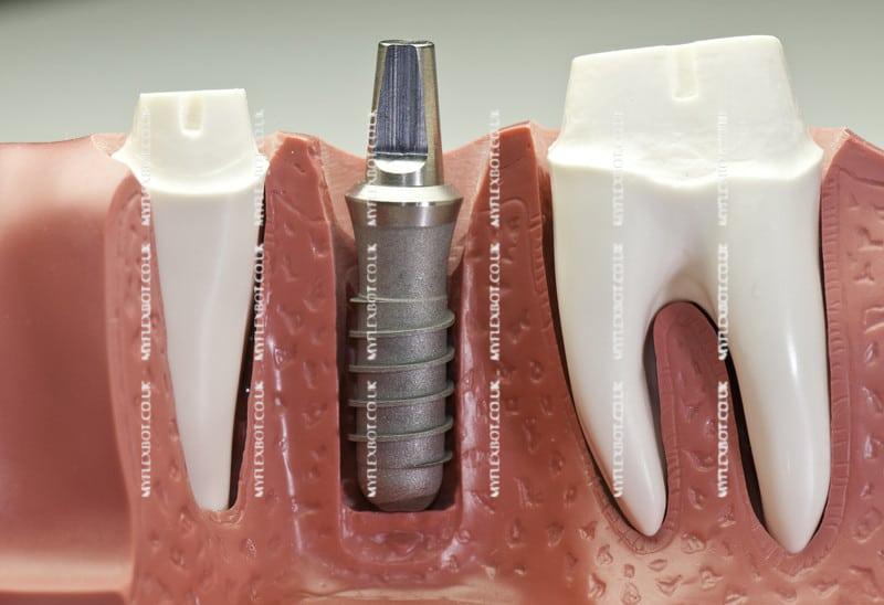 dental implants