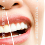Teeth Whitening