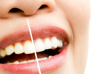 Teeth Whitening