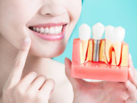 Best Dental Implants