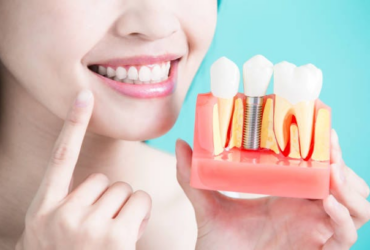 Best Dental Implants