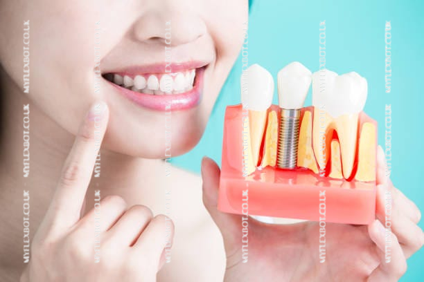 Best Dental Implants