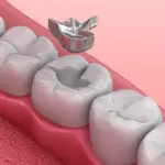 The Science and Stories of Dental Fillings