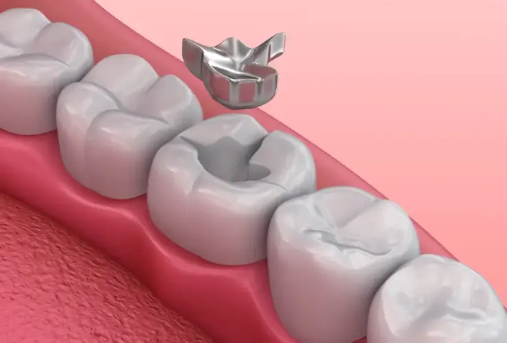 The Science and Stories of Dental Fillings