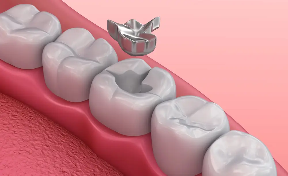 The Science and Stories of Dental Fillings