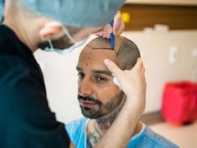 Understanding FUE Hair Transplant Costs: A Comprehensive Guide