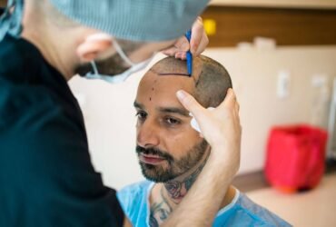 Understanding FUE Hair Transplant Costs: A Comprehensive Guide