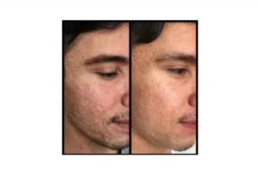 PRP Face Therapy