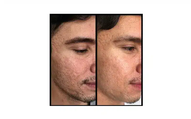 PRP Face Therapy